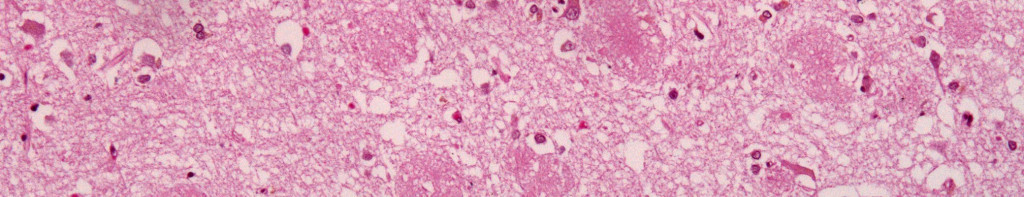 Amyloid_plaques_alzheimer_disease_HE_stain crop2
